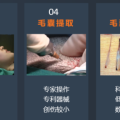 【招募志愿者】“脫發(fā)”有救了！ 隨州市中心醫(yī)院醫(yī)療美容科面向社會(huì)招募“毛發(fā)移植”體驗(yàn)者！