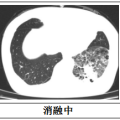 隨州市中心醫(yī)院：【特色技術(shù)】微創(chuàng)技術(shù)新突破，冷凍消融治療精準(zhǔn)“凍殺”癌細(xì)胞