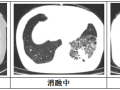 隨州市中心醫(yī)院：【特色技術(shù)】微創(chuàng)技術(shù)新突破，冷凍消融治療精準(zhǔn)“凍殺”癌細(xì)胞