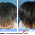 隨州市中心醫(yī)院：告別“禿”然焦慮 CGF讓秀發(fā)重生